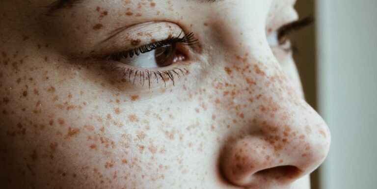 Freckles(Discrete Pigmentation)